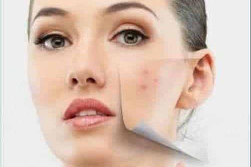 Acne Viso