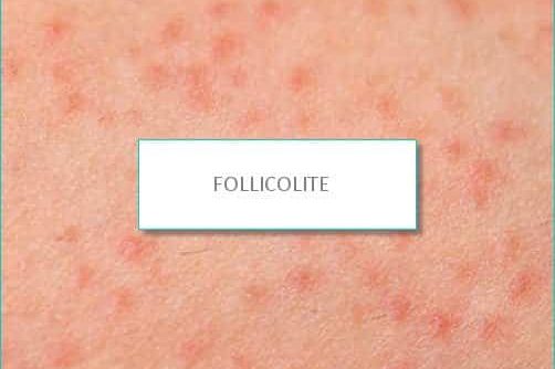 follicolite