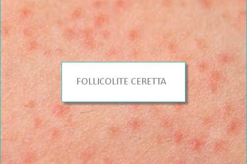FOLLICOLITE CERETTA