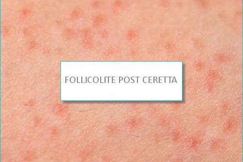 follicolite post ceretta