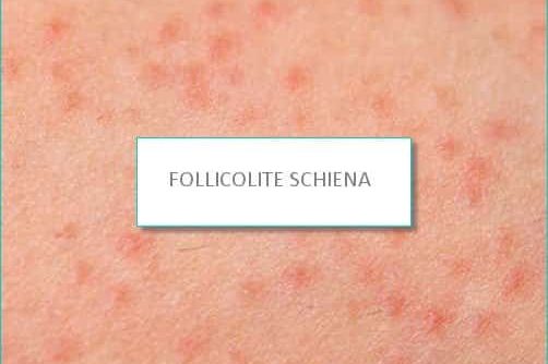 follicolite schiena