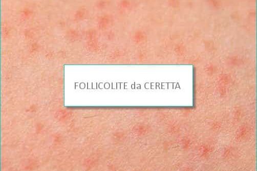 FOLLICOLITE DA CERETTA