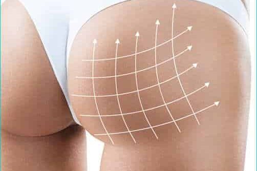 cellulite come eliminarla