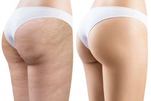 GLUTEI CELLULITE