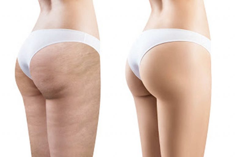 QUANDO ESCE LA CELLULITE
